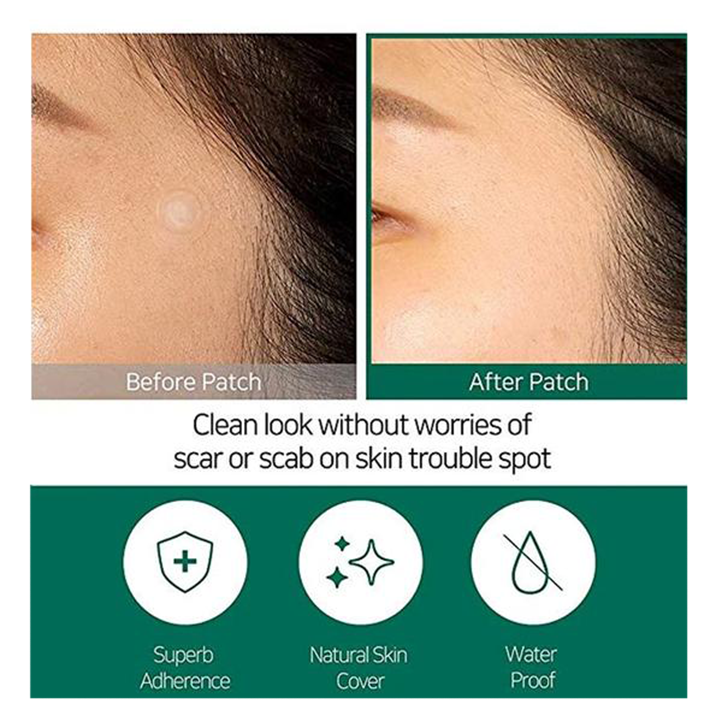 30 Days Miracle Acne Clear Spot Patch